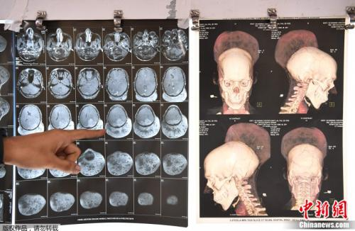 31岁男子帕尔的后脑均附着近2公斤的肿瘤，令其视力受损、持续头痛。